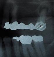 Röntgenbild mit apikaler Aufhellung am Zahn 27