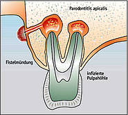 Zusammenhang zwischen Fistel und apikaler Parodontitis