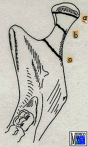 Frakturen des Gelenkfortsatzes:a: Kondylusfraktur,b: Kollumfraktur,c: Gelenkfortsatzbasisfraktur