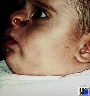 Unvollständige schräge Gesichtsspalte bei einem acht Monate alten Jungen