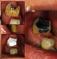 Phosphatzementprovisorium im Zahn