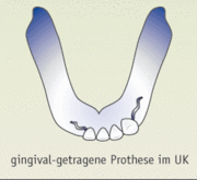 Gingival-getragene Prothese