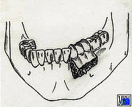 Alveolarfortsatzfraktur