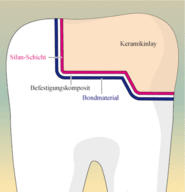 Befestigung eines Keramikinlays im Zahn