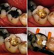 Mesiale und distale Approximalkaries am Zahn 46