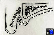 Anteriore Region des Oberkiefers mit Lappenfibrom und Schlotterkamm