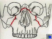 Mittelgesichtsfraktur Le Fort II