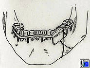 Versorgung einer Unterkieferfraktur durch Draht-Kunststoff-Schiene mit Prothesensattel und perimandibulärer Drahtumschlingung als monomaxilläre Fixation