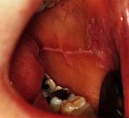 Schleimhautveränderungen durch Ansaugen zwischen die Zähne