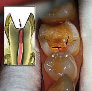 Pulpaeröffnung am Zahn 36