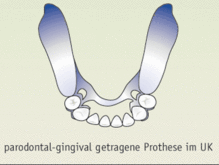Parodontal-gingival getragene Prothesen