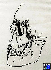 Nach Vorverlagerung des Mittelgesichtsfragments werden die Spalträume (Tuber maxillare, Nasenwurzel, Orbitaränder und Jochbögen) mit Knochentransplantaten ausgefüllt. Fixation durch Miniplattenosteosynthese.