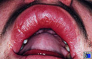 Cheilitis granulomatosa bei Melkerson-Rosenthal-Syndrom