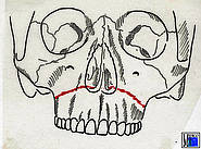 Mittelgesichtsfraktur Le Fort I