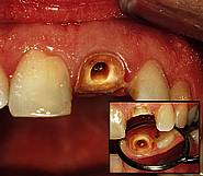 Vorbereiteter Zahnstumpf nach Wurzelbehandlung