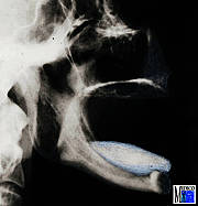 Fernröntgenaufnahme mit ausgeprägter Prognathie des Unterkiefers
