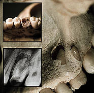 Auswirkungen der apikalen Parodontitis für den Knochen