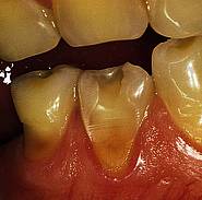 Schmelz-/Dentinerosionen