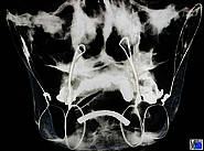 Situation nach zygomatiko-maxillärer Aufhängung des Unterkiefers unter Verwendung der vorhandenen Prothesen. Die intermaxilläre Fixation erfolgte durch Drahtaufhängung an den Jochbögen und an der Apertura piriformis