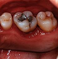 Aggressive Parodontitis am Zahn 26