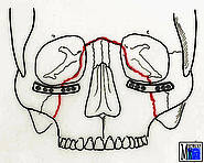 Miniplattenosteosynthese bei Le-Fort-II-Fraktur