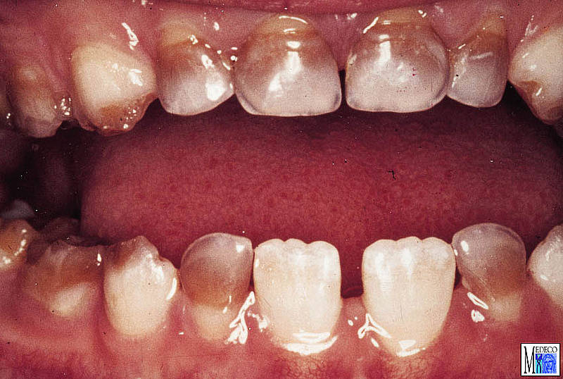 Schiefe Zähne: Schönheitsmakel oder ernstes Problem?
