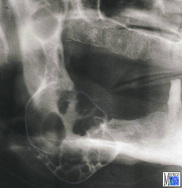 Odontogene Tumoren